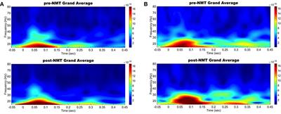 Preliminary Neurophysiological Evidence of Altered Cortical Activity and Connectivity With Neurologic Music Therapy in Parkinson's Disease